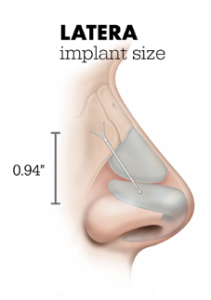 This illustration shows where the LATERA nasal implant is placed in the nose